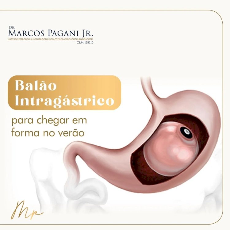 Balão Intragástrico  para chegar em forma no verão
